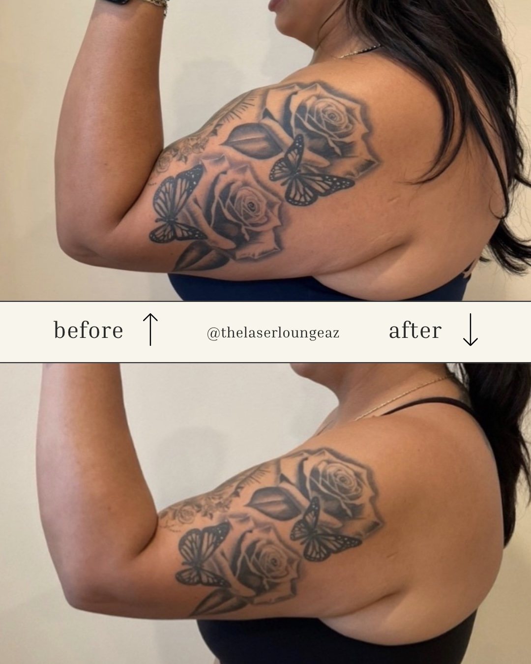 Real client before and after RF arm tightening: loose upper-arm skin before; firmer, smoother, more toned arm after 7 treatments