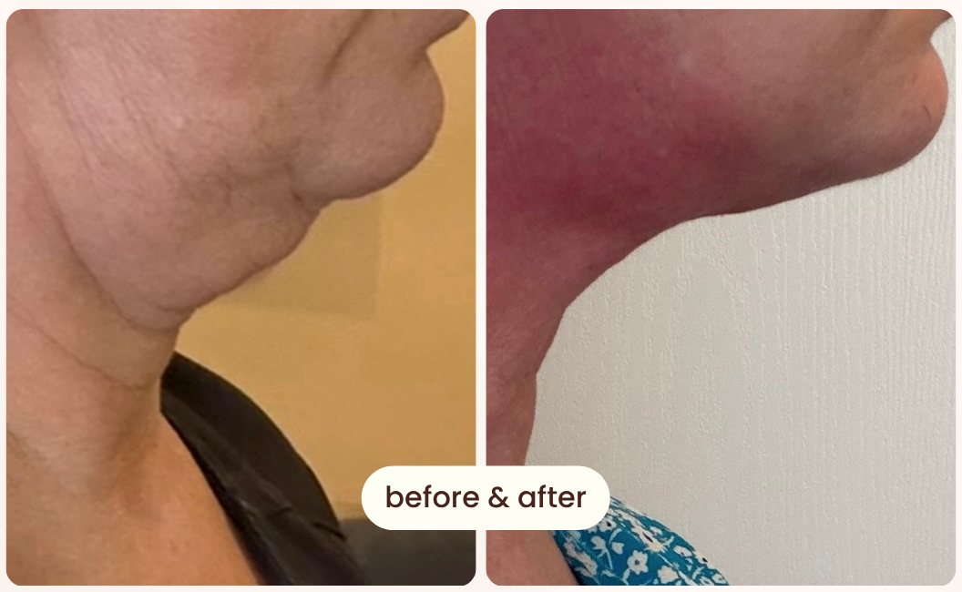 Real client before and after RF neck and chin tightening: loose, sagging skin under the chin before; a tighter, more defined jawline after 7 treatments