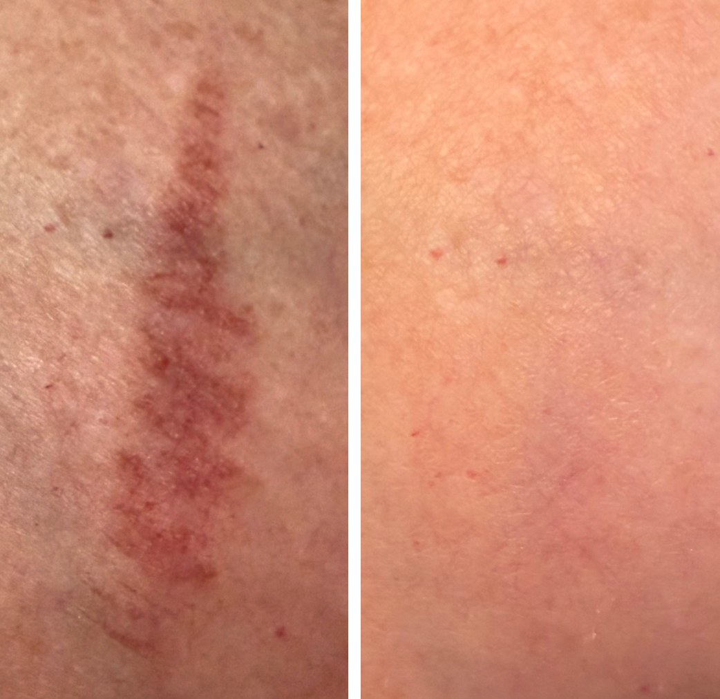 Real client before and after Scar-Letting Go scar revision: a raised, red scar before; smooth skin with the scar barely visible after treatment